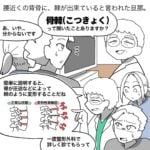 【腰痛の原因は骨の棘！？】